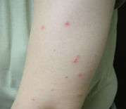 Bed bug bites - Teaneck Exterminators in Teaneck, NJ